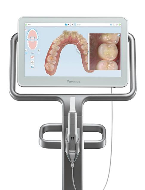 iTero digital impressions system