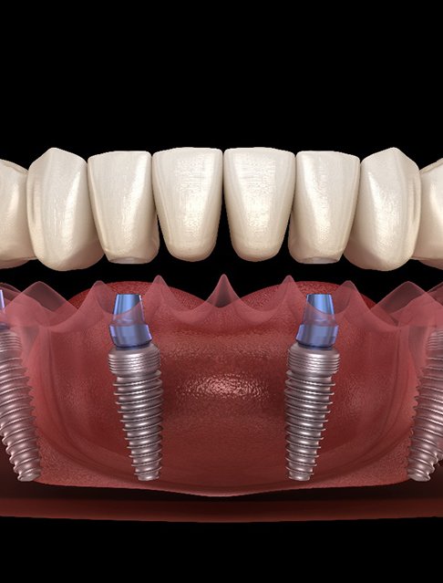 A 3D illustration of all-on-4 implants