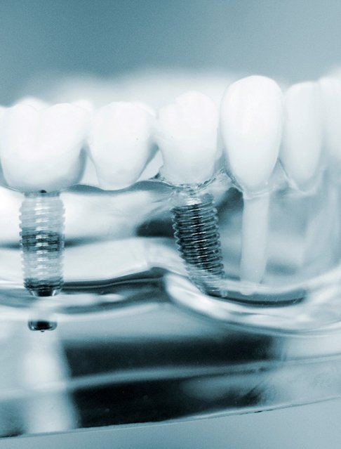 A closeup of two dental implants in a jaw mockup