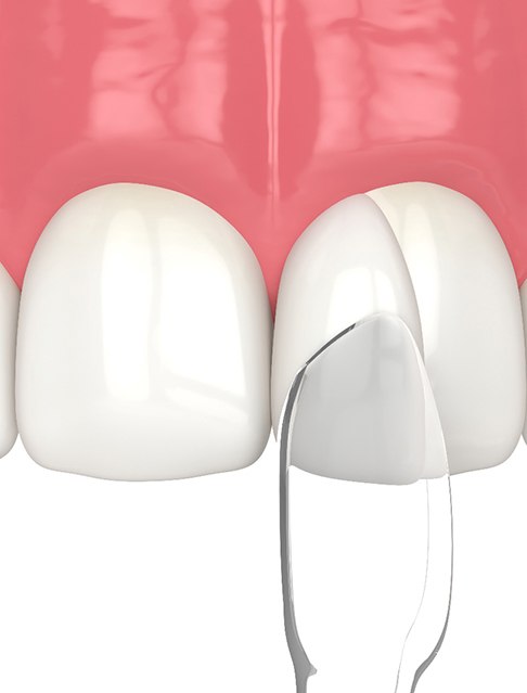 Dentist hardening dental bonding with light