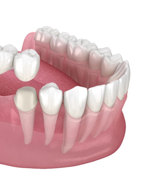 Illustration of traditional dental bridge in Marana, AZ being placed