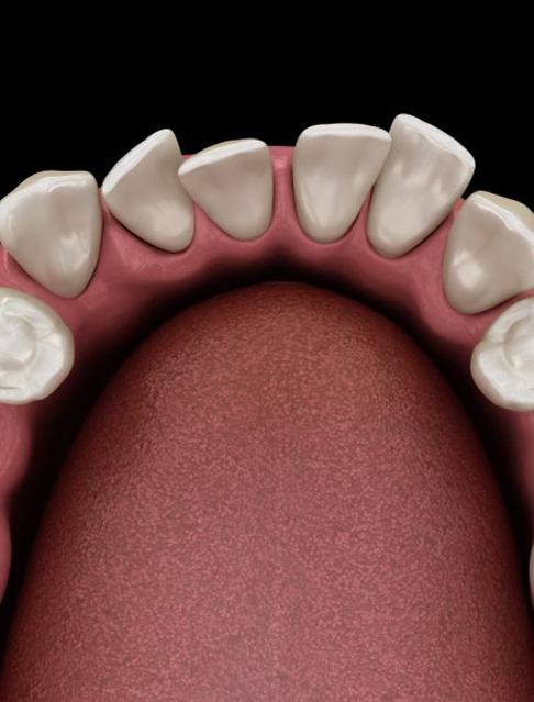 Illustration of crowded teeth viewed from above