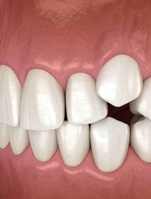 Illustration of partially impacted canine tooth