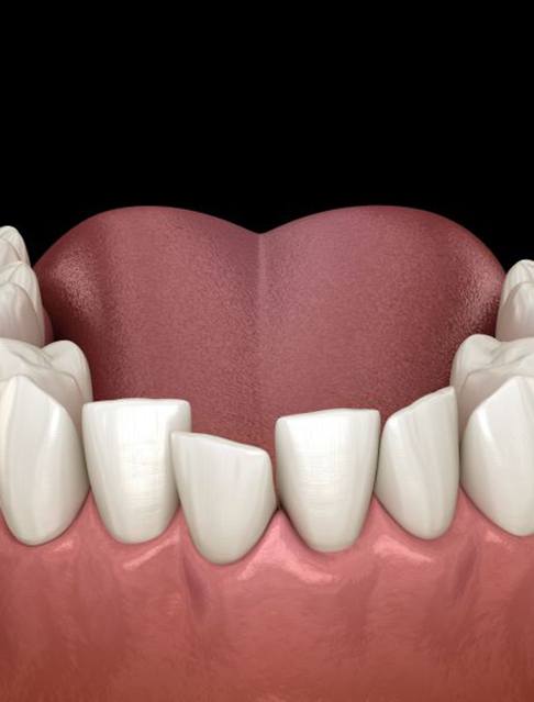 Illustration of crooked, overcrowded teeth