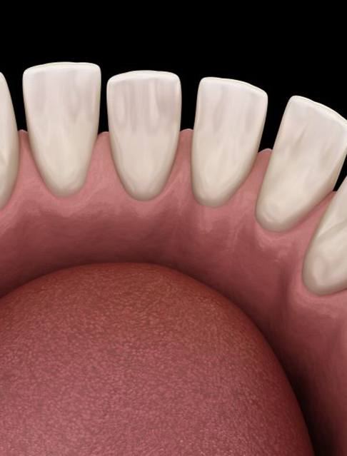 Gapped teeth in lower arch viewed from above