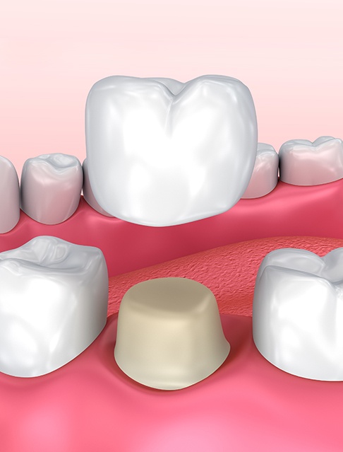 Animated dental crown placement