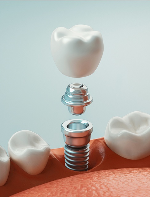 Animated dental implant supported dental crown placement