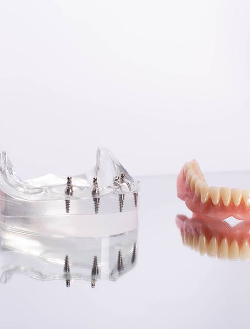 Set of implant dentures next to clear base with several dental implants