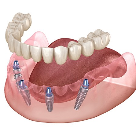 Rendering of fixed implant dentures in lower arch with white background