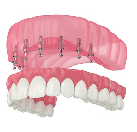 Rendering of ball-retained implant dentures in upper arch with white background