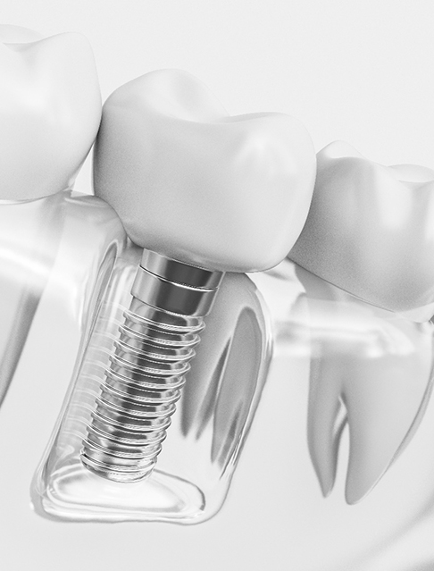 3D model of a dental implant