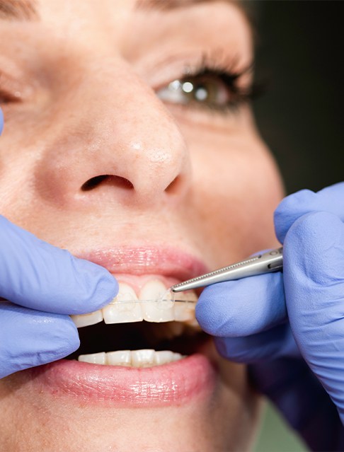 Dentist placing clear and ceramic braces