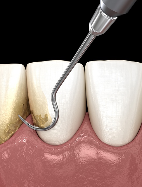 Animated smile during scaling and root planing