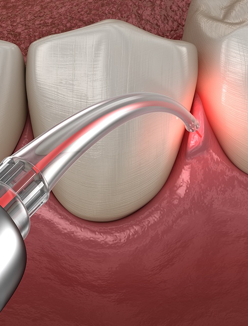 Animated smile during laser periodontal therapy