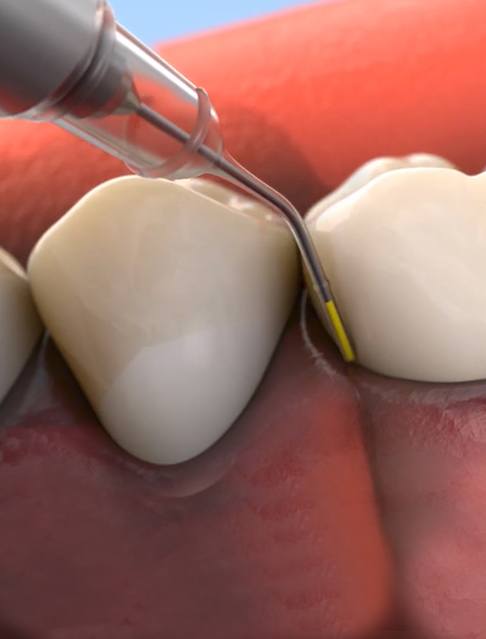 Animated smile during antibiotic therapy