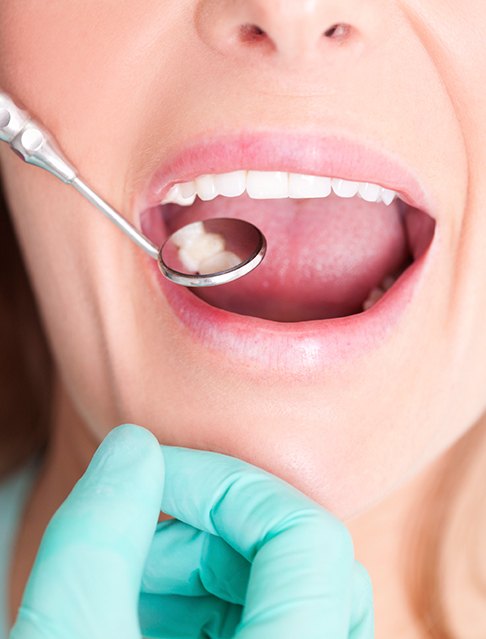 Dentist checking patient's smile after tooth colored filling restoration