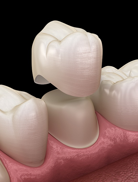 Animated smile during dental crown restoration