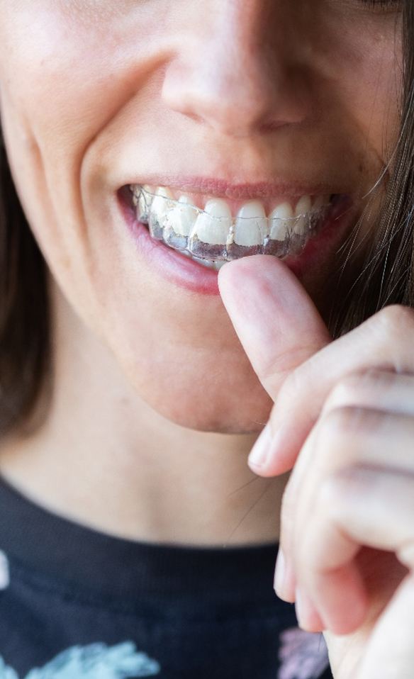 woman putting on Spark Clear Aligner and smiling  