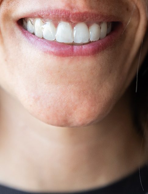 closeup of woman smiling with Spark Clear Aligner