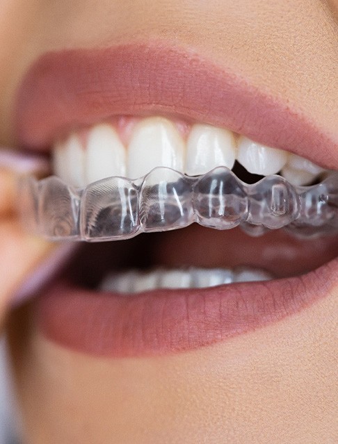 Close-up of clear aligner being placed on teeth