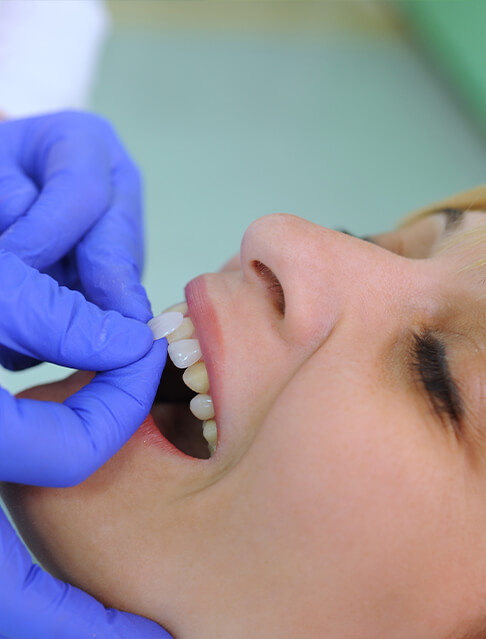 woman getting veneers in Marana