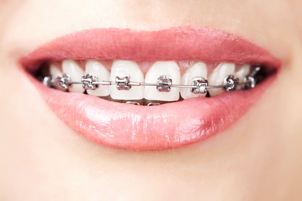 close-up smile with braces