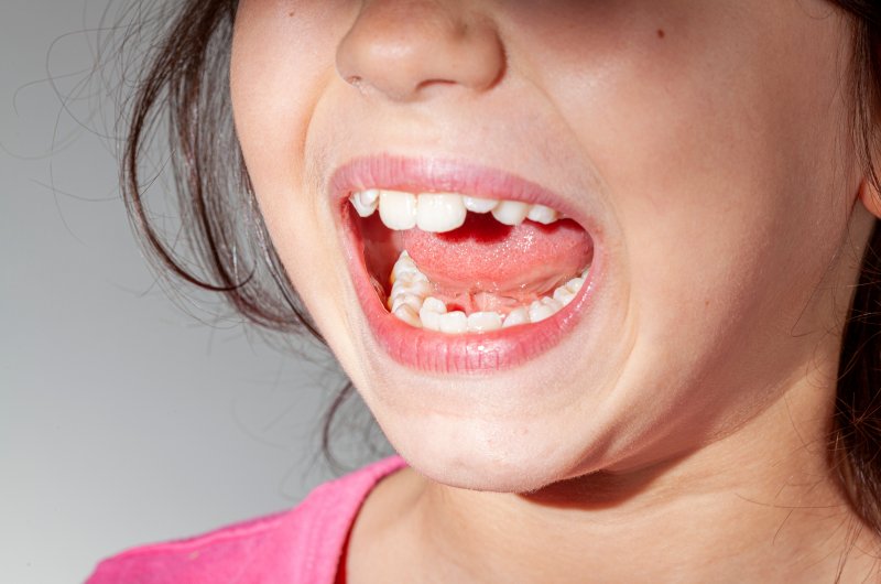 A young girl who needs braces with baby teeth 