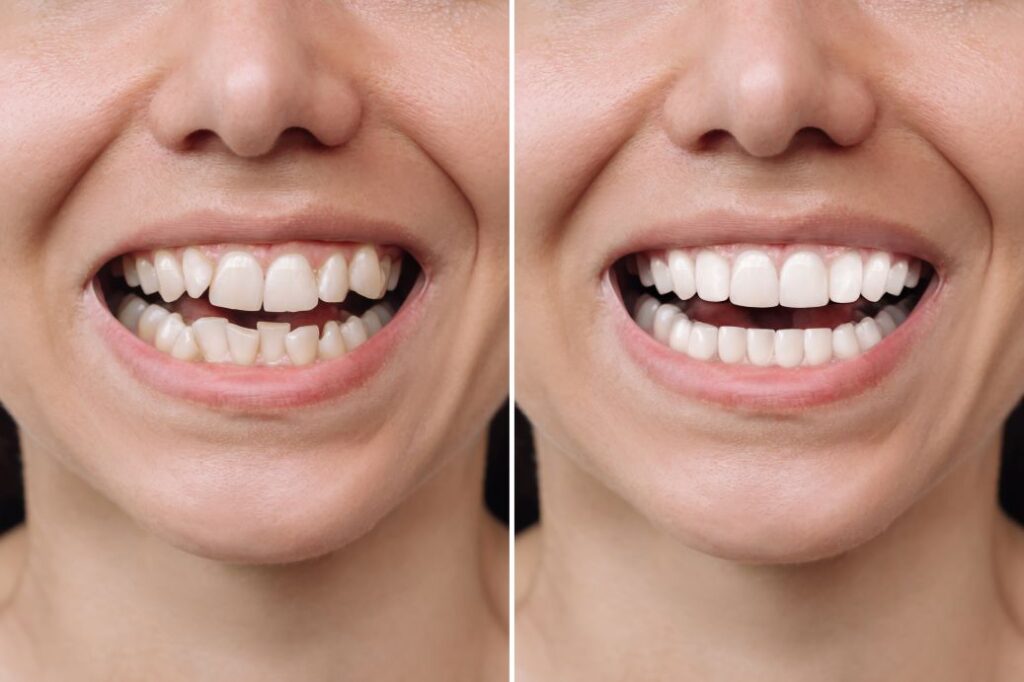 A woman’s smile before and after getting veneers