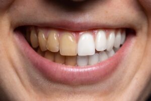 before and after photo of stained and whitened teeth